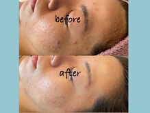 リレイスフクオカ(RelaceFUKUOKA)/コルグン＋ツヤ肌＋脱毛