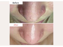 エクシア(Excia)/次世代毛穴洗浄