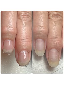 スマイルニコ(smile nico)/深爪の長さ出し部分が自爪に