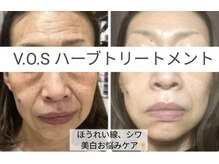 エクラ(Eclat)/VOS/フェイシャル/毛穴洗浄/美白