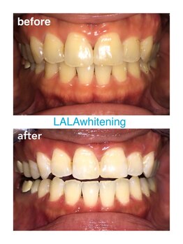 ララホワイトニング/Before&After強力ホワイトニング