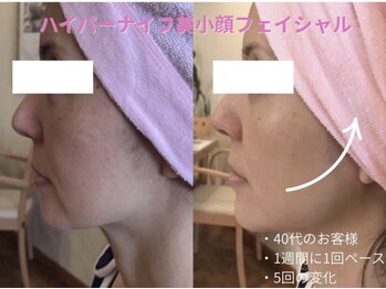 エステティックサロン アールグレー 名古屋駅店/ハイパーナイフ小顔フェイシャル