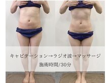 【痩身】お腹くびれコース　施術時間/30分