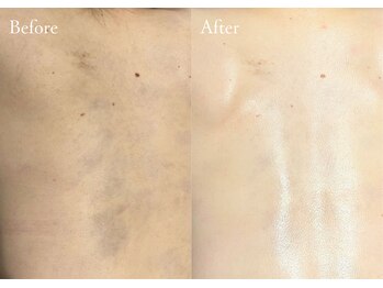 シューラディアント(ShuRadiant)/背中ケア/ブライダル