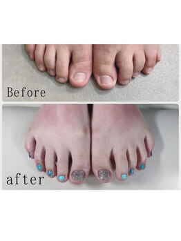 ティアラネイル 宇都宮/深爪矯正