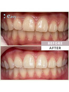 イージーホワイトニング 五反田店(easy whitening)/セルフホワイトニング症例写真