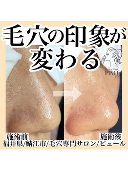 ピュール 鯖江店(PUR)/毛穴/毛穴ケア/毛穴洗浄