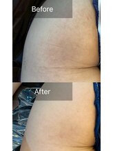 ビビ(VIVI)/おしりのケアに