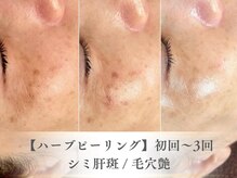 ベルペール(Belle perle)/【ハーブピーリング】毛穴/シミ