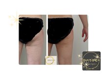 ひぺりかむ/【脂肪冷却】ヒップ下2ブロック