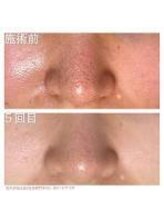 ウェルビーイング(well-being)/毛穴トラブルにお悩みの方