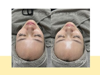 スキンラボ ドットシキブ 厚木海老名店(skinlabo .sikibu)/ララピール＋毛穴洗浄コース★