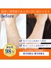 【平日限定♪/都度払い】顔全体脱毛＋腕全体脱毛　14300円→11000円