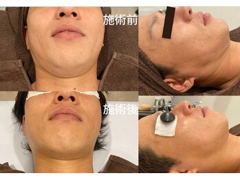 ロワ(Roi)/1回で感動の変化/光フェイシャル