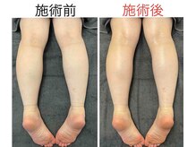 むらた整骨接骨院/”脂肪燃焼”　ダイエット