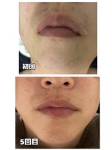 ダンニヒル(dannihil)/【髭脱毛】30代会社員5回目