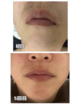 ダンニヒル(dannihil)/【髭脱毛】30代会社員5回目