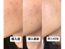 リンダ 西宮店(LINDA)/剥離なしハーブピーリング