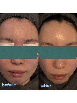 ヒトヒ(HITOHI)/ツヤ肌タマゴ肌☆