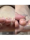 【巻き爪でお悩み】のお客様