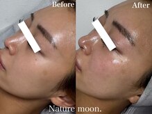 ナチュールムーン(Nature moon.)/ピーリング