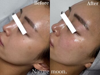 ナチュールムーン(Nature moon.)/ピーリング