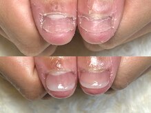 深爪矯正 爪悩み専門店 グラシナ 西宮北口店【4/3 NEW OPEN（予定）】/(深爪/長さだし/フィルイン)