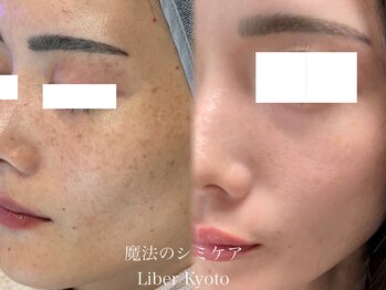 エステティック リベル キョウト 京都駅前店(Esthetic Liber Kyoto)/魔法のシミケア