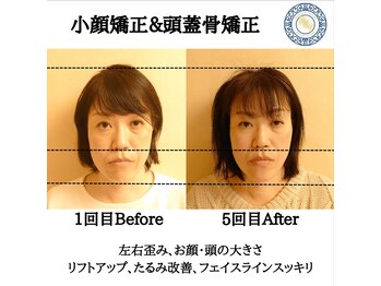 RKY/小顔矯正&頭蓋骨矯正5回(40代)