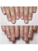 スマイルニコ(smile nico)/深爪矯正メンテナンス