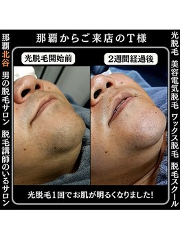 ディースタイル 北谷店(Dstyle)/北谷メンズ脱毛ヒゲBefore after