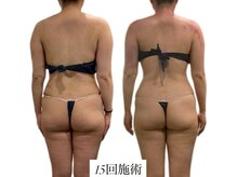 痩身革命 大宮店/カッピングリンパマッサージ