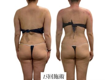 痩身革命 大宮店/カッピングリンパマッサージ