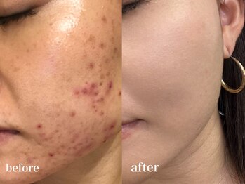 リアルナ(REALUNA)/慢性ニキビが改善