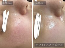 アムールサロン(Amour salon)/ホワイトスノーピール【新宿】