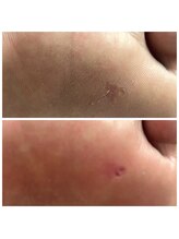 ドクターネイル爪革命 十条店/魚の目ケア