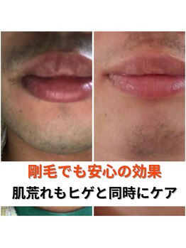 ビーボヌール(be-bonheur)/全顔ヒゲ脱毛 鎮静パック