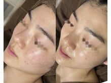 肌質改善専門【Salon da Mahina】毛穴ケア/ニキビケア/ハーブピーリング/ニキビ/ハーブピーリング/藤沢