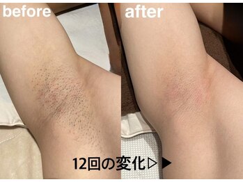チェリー(Cherry)の写真/男女問わず全身ツル肌へ！都度払いで通いやすい脱毛サロンで理想の自分に☆