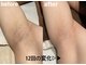 チェリー(Cherry)の写真/男女問わず全身ツル肌へ！都度払いで通いやすい脱毛サロンで理想の自分に☆