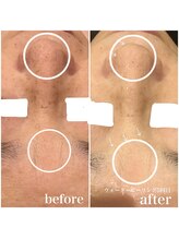 ブローチ 刈谷店(BROOCH)/毛穴悩みはこのコラボお手入れで