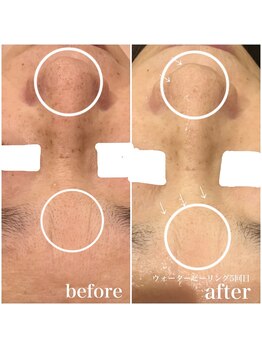 ブローチ 刈谷店(BROOCH)/毛穴悩みはこのコラボお手入れで