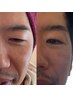 《メンズ人気》【(Lit）ヒト臍帯幹細胞エステ】シミしわたるみ肌質改善(90分)