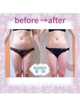 ビサイド(美side)/【痩身】