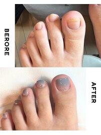 【美爪育成】《フット》深爪改善