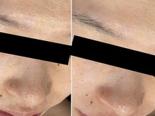 レイズ(RAISE)/顔脱毛×毛穴洗浄