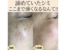パルサロン(palsalon.)/シミを薄くシミのできにくいお肌