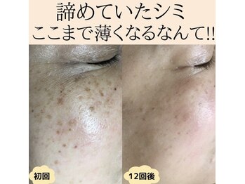 パルサロン(palsalon.)/シミを薄くシミのできにくいお肌