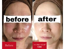 メロー(MELLOW)/ハーブピーリング(赤み/敏感肌)