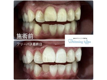 ホワイトニングサロン 熊本店/熊本ホワイトニング